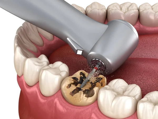 Soins dentaires et traitement des caries à Vienne